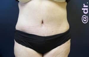 After Image: Liposuction and Tummy Tuck