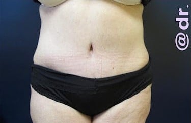 After Image: Liposuction and Tummy Tuck - front