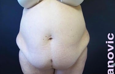 Before Image: Liposuction and Tummy Tuck - front