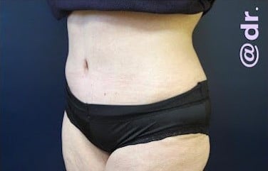 After Image: Liposuction and Tummy Tuck - left-front-oblique