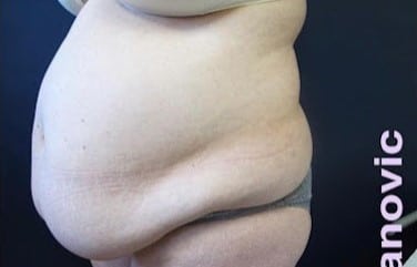 Before Image: Liposuction and Tummy Tuck - left-front-oblique