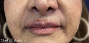 After Image: Lip Filler