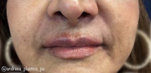 After Image: Lip Filler - front