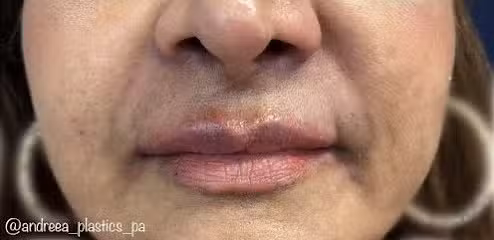 After Image: Lip Filler - front
