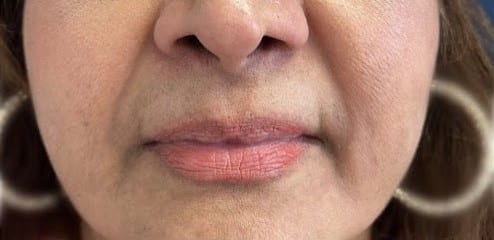 Before Image: Lip Filler - front