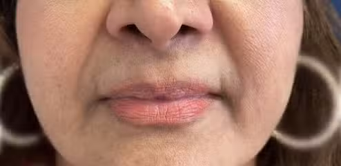 Before Image: Lip Filler - front