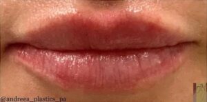 After Image: Lip Filler