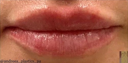 After Image: Lip Filler - front