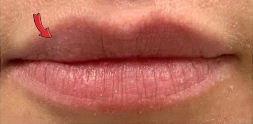 Before Image: Lip Filler - front