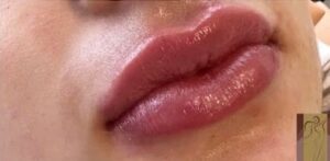 After Image: Lip Filler