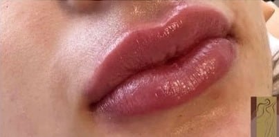 After Image: Lip Filler - right-front-oblique