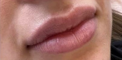 Before Image: Lip Filler - right-front-oblique