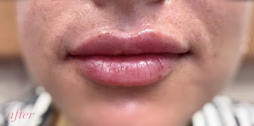 After Image: Lip Filler - front