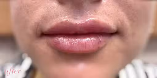 After Image: Lip Filler - front