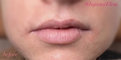 Before Image: Lip Filler - front