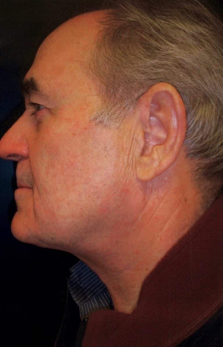 After Image: Anterior Cervicoplasty - left-side