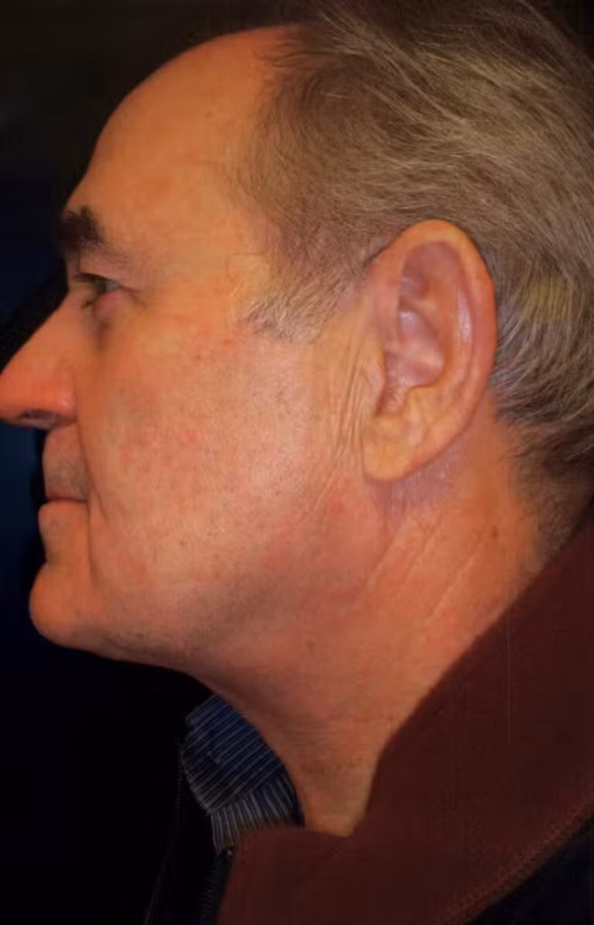 After Image: Anterior Cervicoplasty - left-side