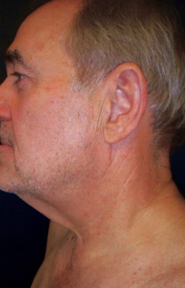 Before Image: Anterior Cervicoplasty - left-side