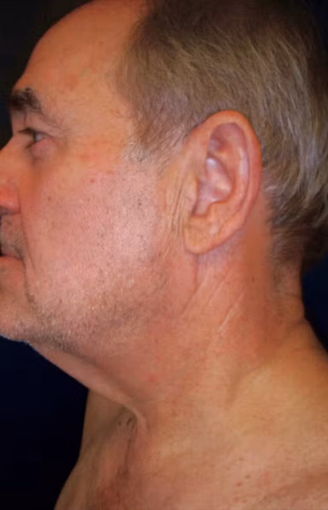 Before Image: Anterior Cervicoplasty - left-side