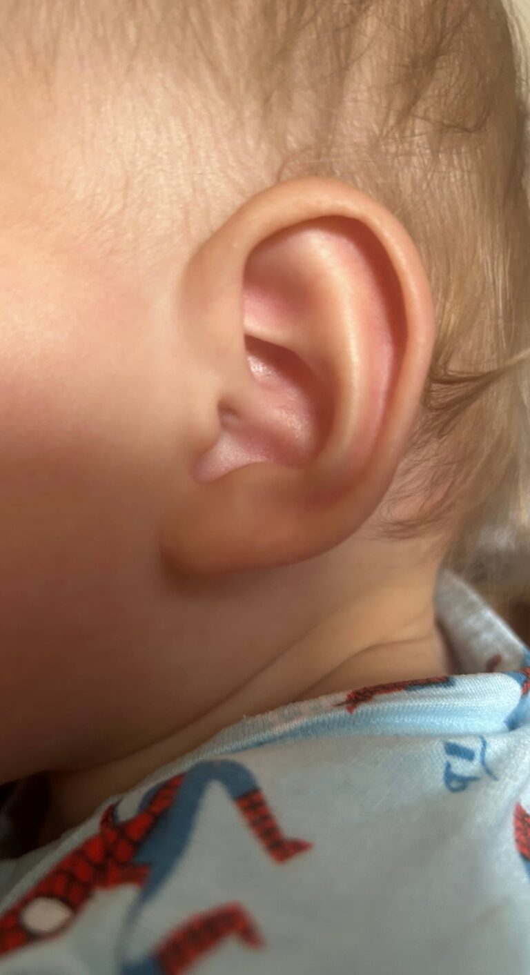 After Image: Ear Reshaping - right-side