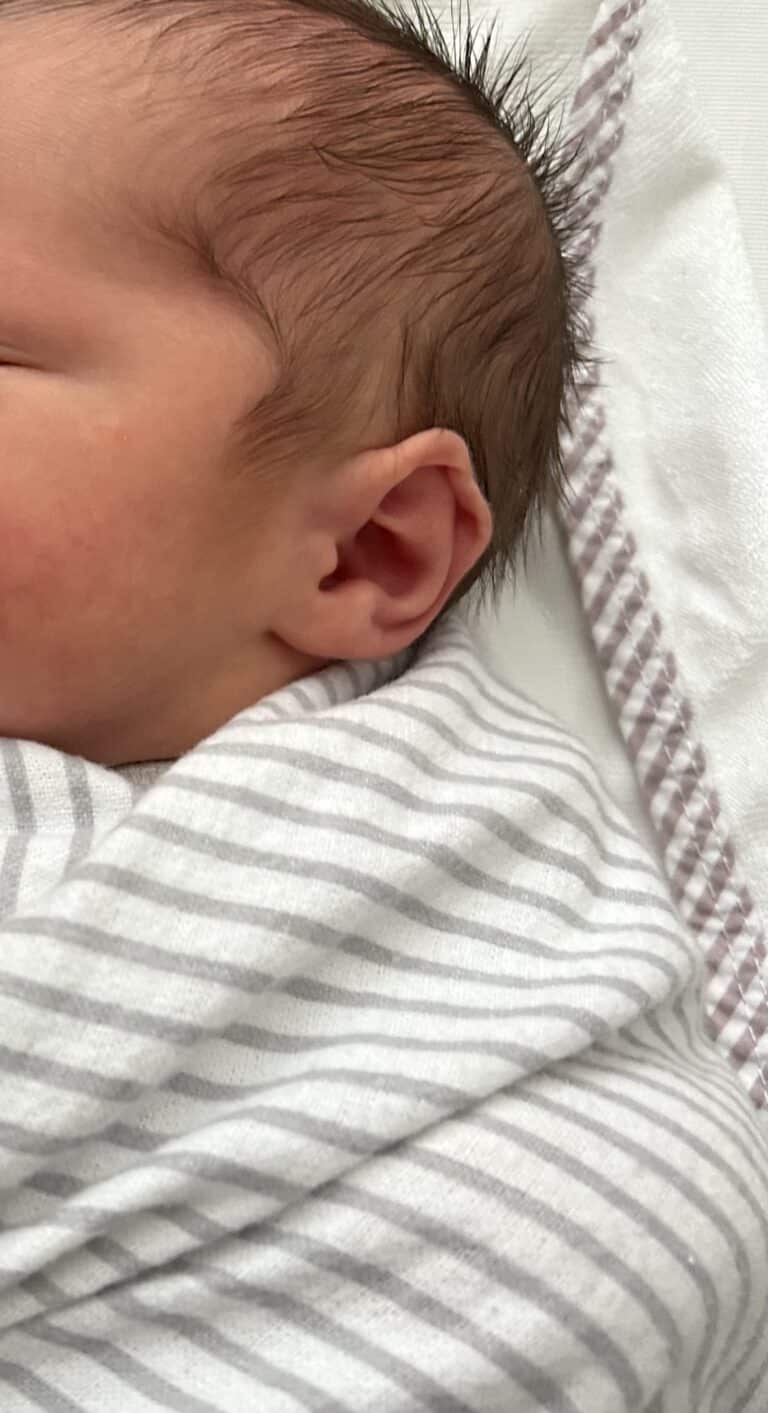 Before Image: Ear Reshaping - right-side