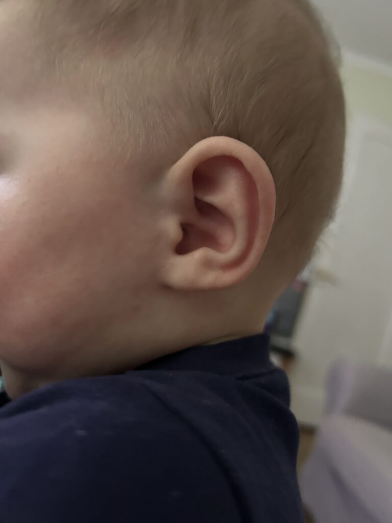 After Image: Ear Reshaping - front