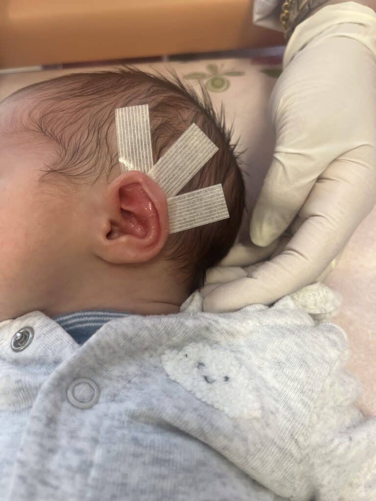 Before Image: Ear Reshaping - front