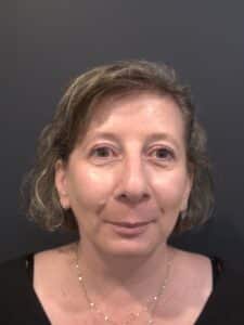 After Image: Upper Blepharoplasty