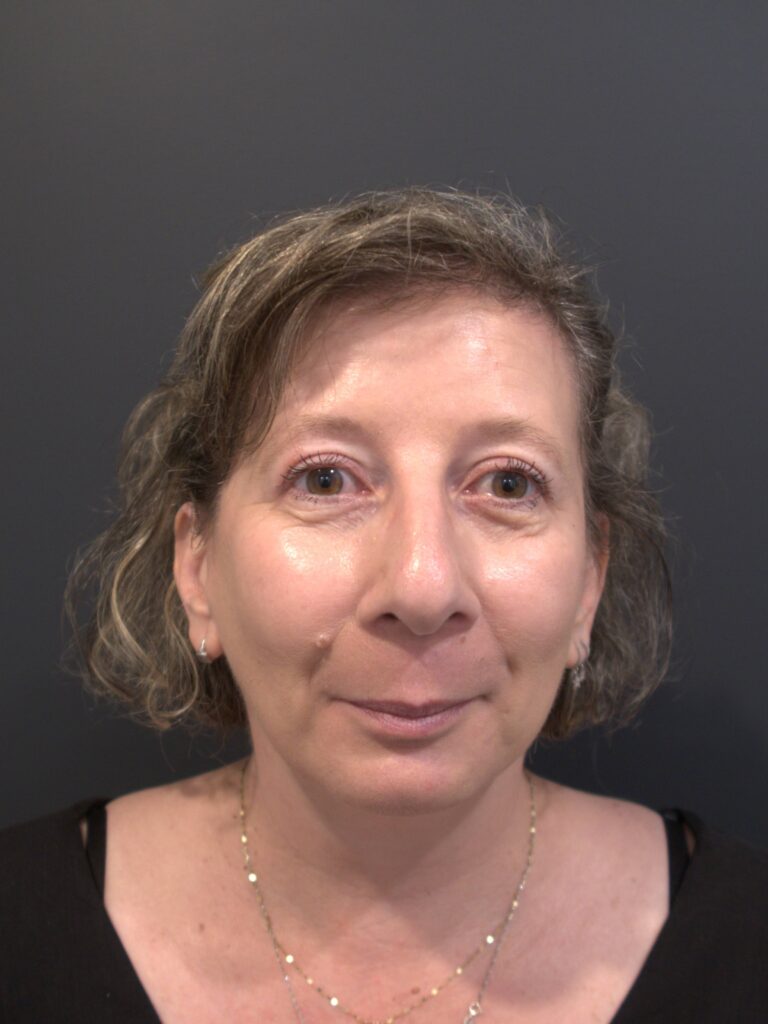 After Image: Upper Blepharoplasty - front