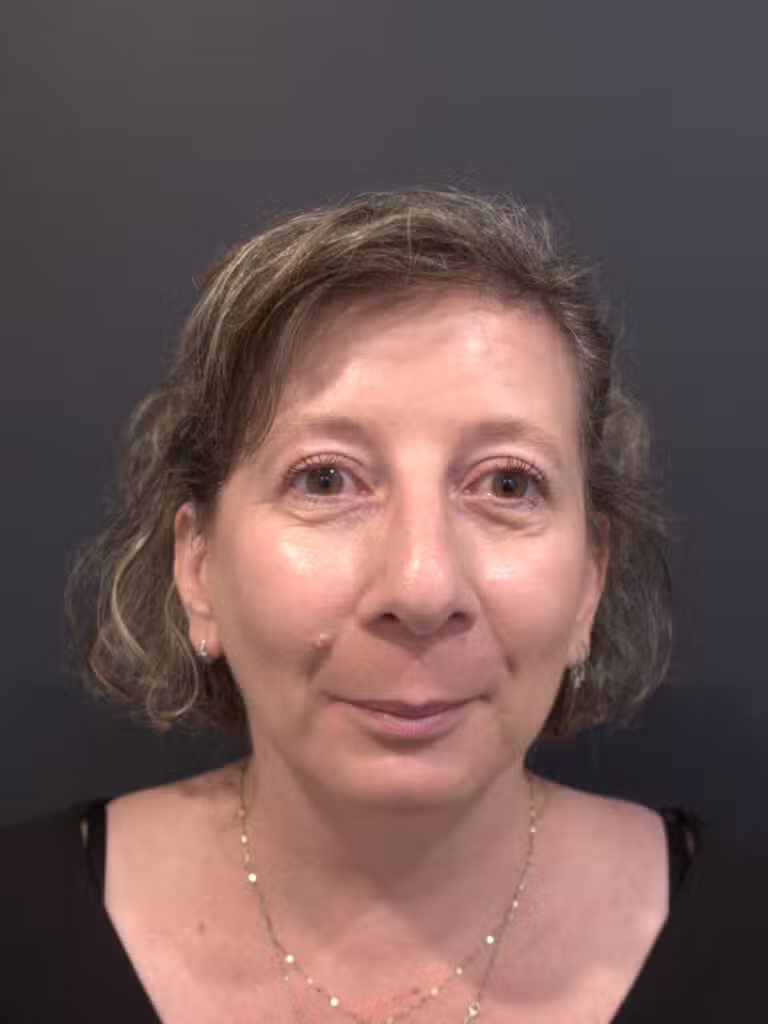 After Image: Upper Blepharoplasty - front