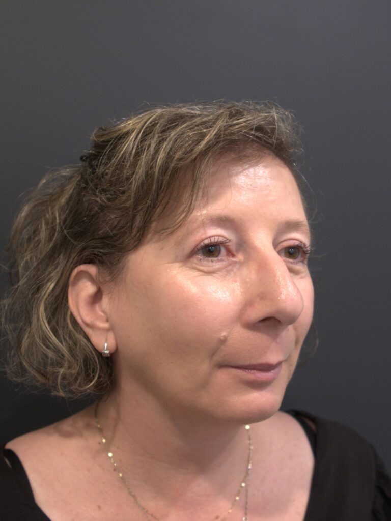 After Image: Upper Blepharoplasty - left-side