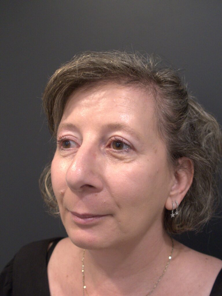 After Image: Upper Blepharoplasty - right-side