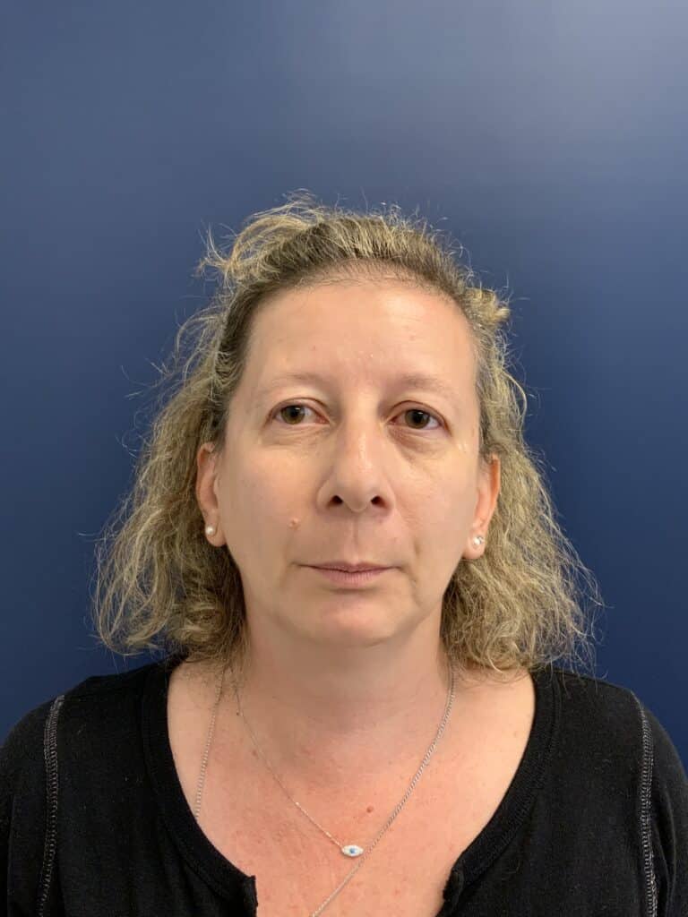 Before Image: Upper Blepharoplasty - front