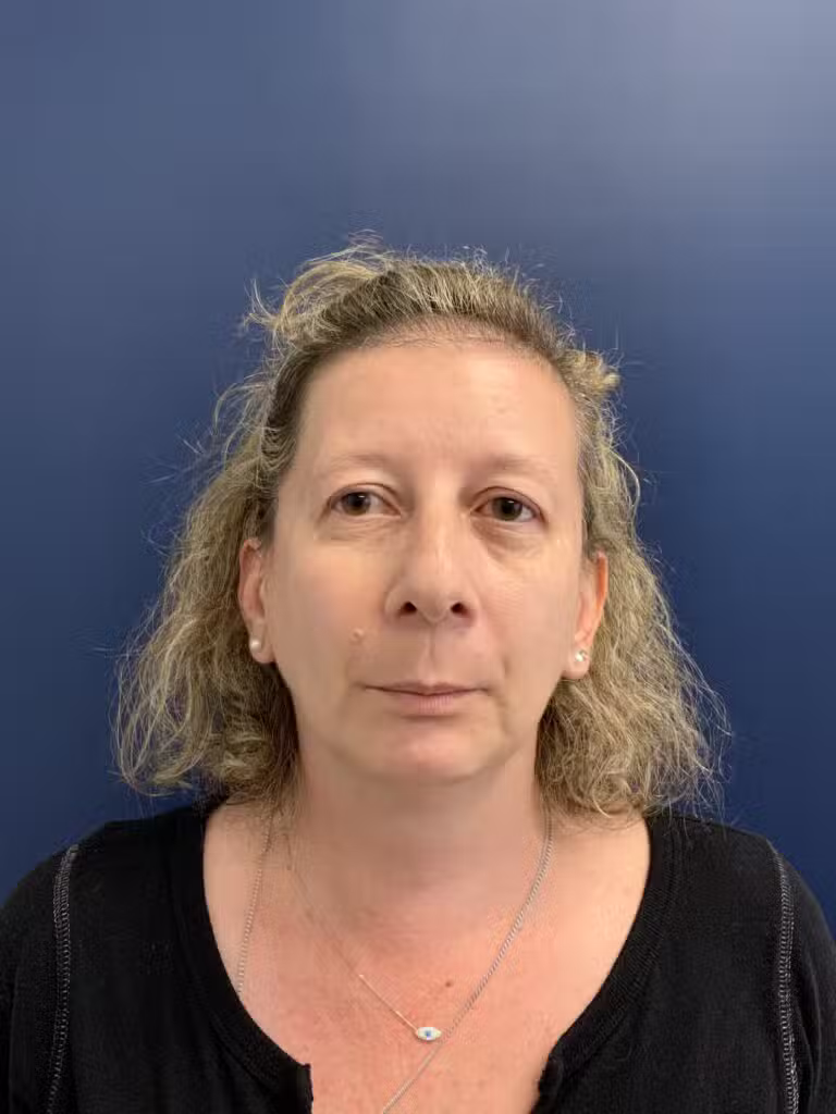 Before Image: Upper Blepharoplasty - front