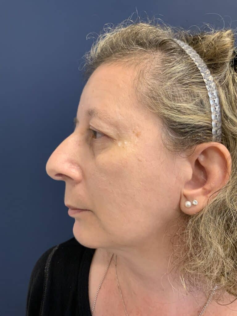 Before Image: Upper Blepharoplasty - right-side
