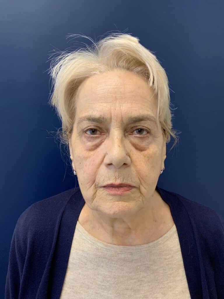 After Image: Upper Blepharoplasty - front