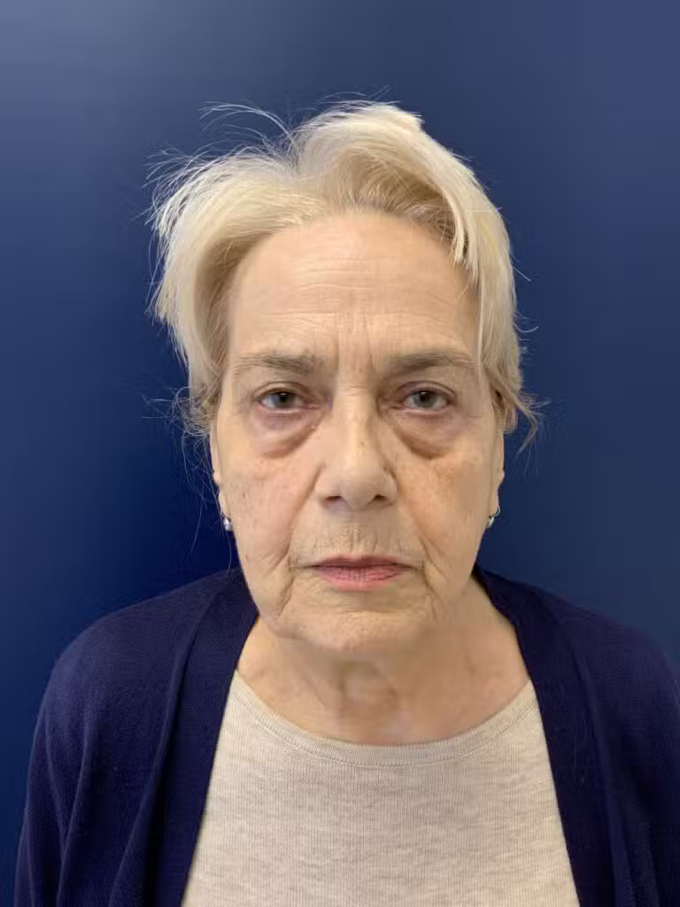 After Image: Upper Blepharoplasty - front