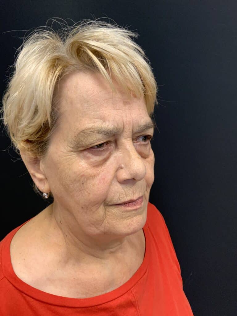 Before Image: Upper Blepharoplasty - left-side
