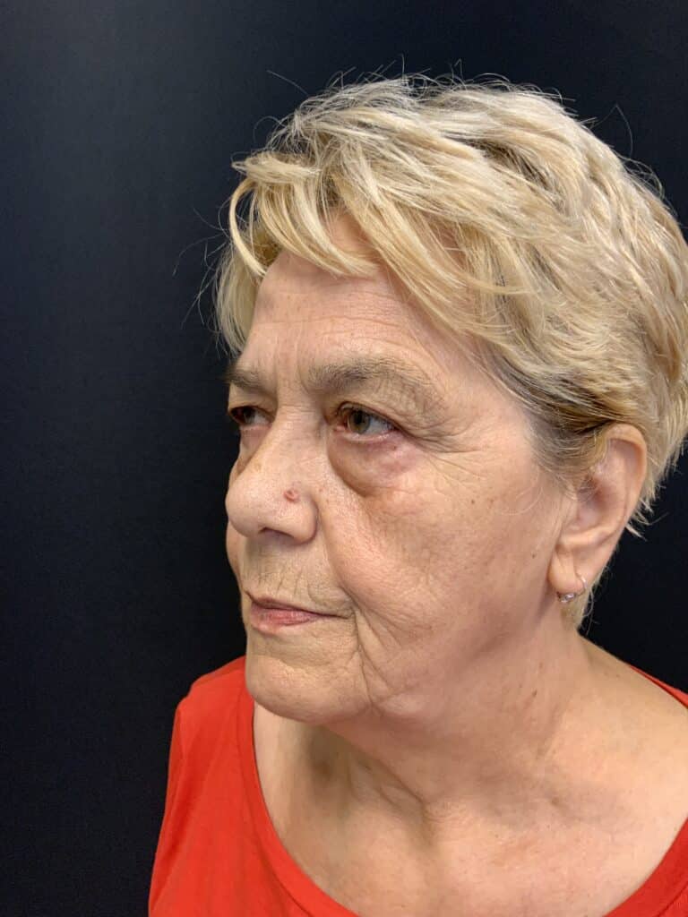 Before Image: Upper Blepharoplasty - right-side