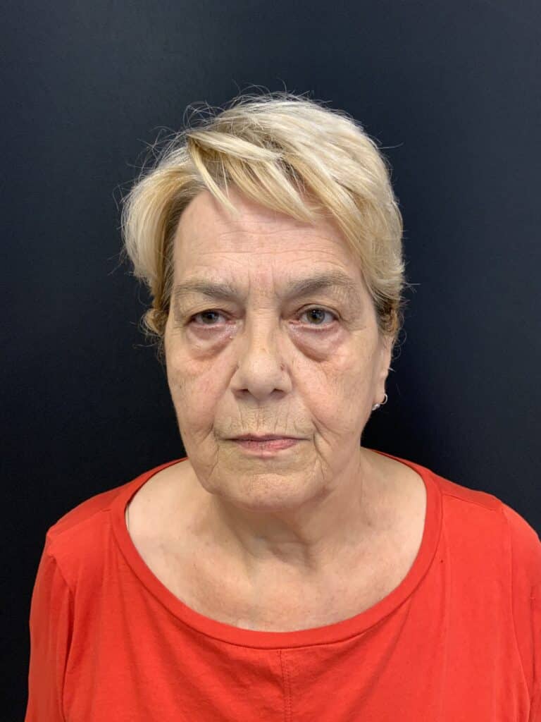 Before Image: Upper Blepharoplasty - front