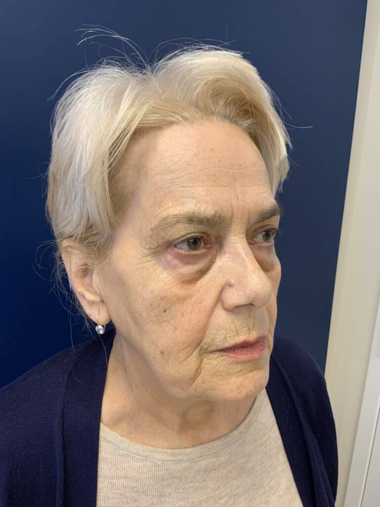 After Image: Upper Blepharoplasty - left-side
