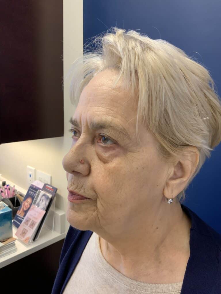 After Image: Upper Blepharoplasty - right-side