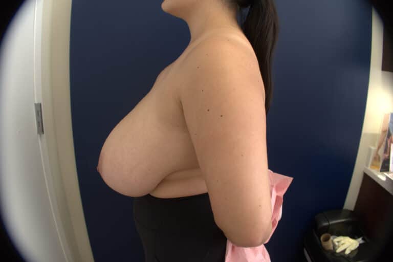 Before Image: Breast Reduction - right-side