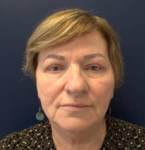 After Image: Upper Blepharoplasty