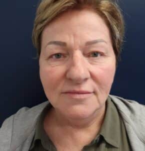 Before Image: Upper Blepharoplasty