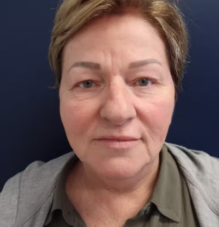 Before Image: Upper Blepharoplasty - front