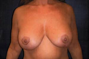 After Image: Breast Augmentation