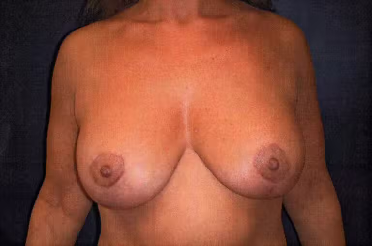 After Image: Breast Augmentation - front