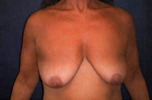 Before Image: Breast Augmentation
