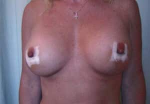 After Image: Breast Augmentation
